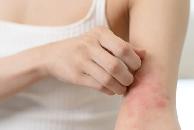 Los niños con obesidad tienen más probabilidad de eccema y psoriasis